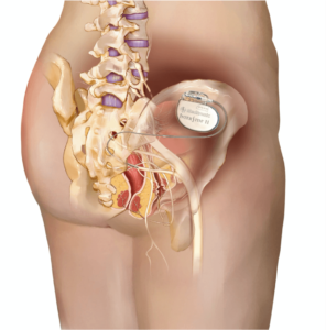 Sacral nerve stimulation