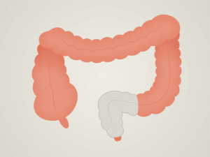 Post-surgical bowel (LARS)