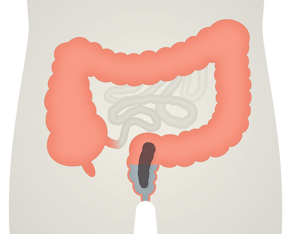 illustration of bowel irrigation low volume