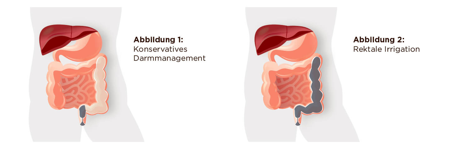 Rectal irrigation vs conservative bowel management